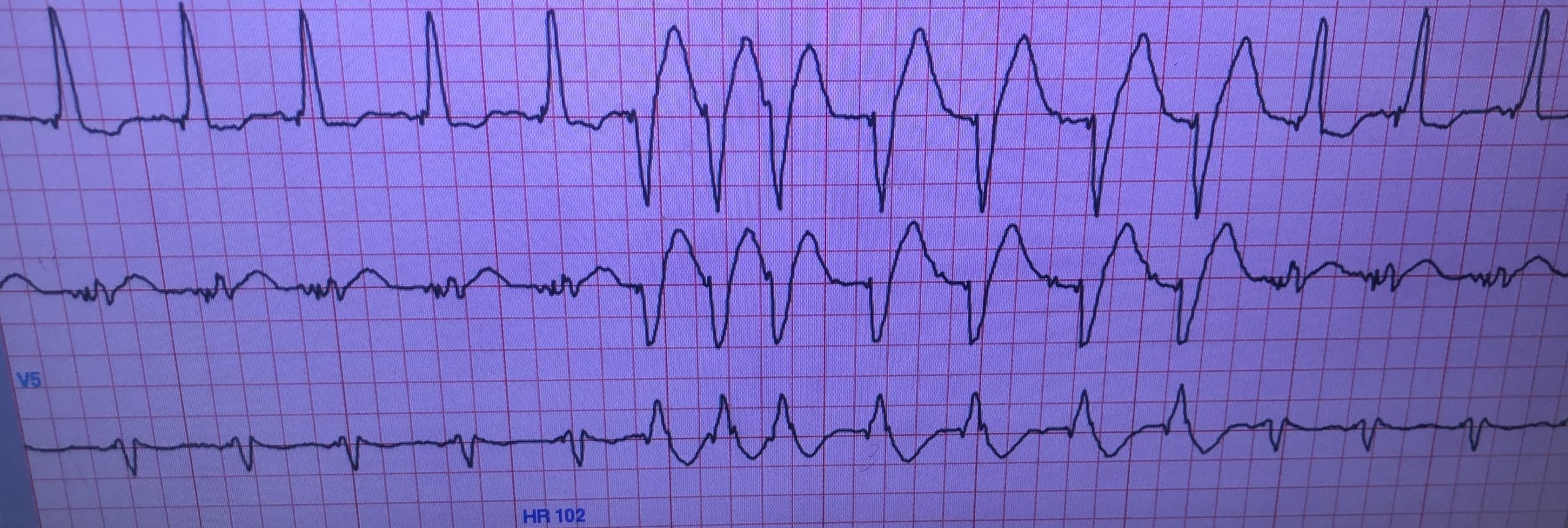 How To Interpret Inpatient Cardiac Telemetry | Marc Katz MD