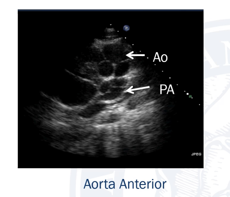 Apical 4 chamber view showing anterior transposed aortic valve with posterior pulmonary valve behind it