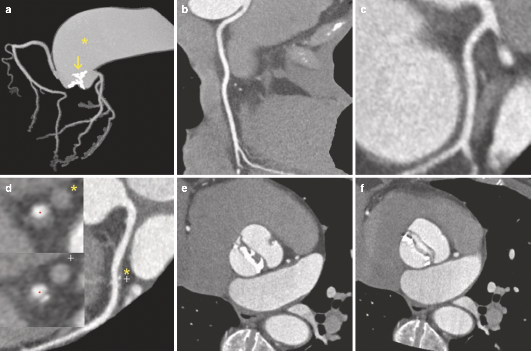 Bicuspid AV with aortic dilation, and non-obstructive mixed plaque with evidence of positive remodeling`