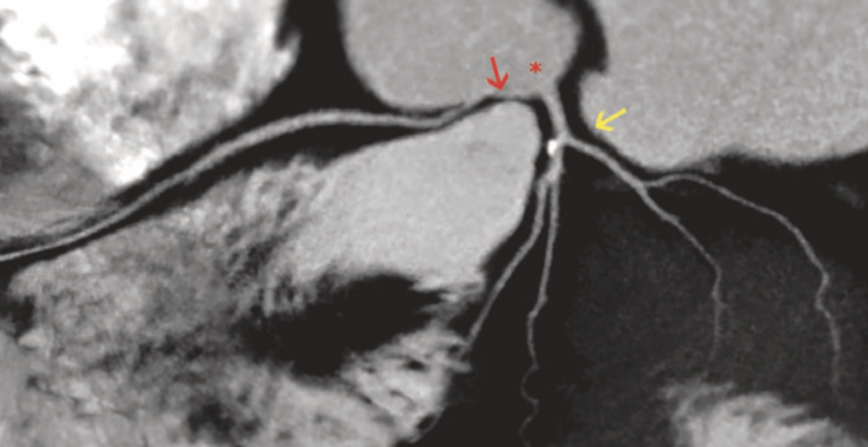 Right coronary artery originating from the left coronary sinus. RCA in red, Left main coronary artery yellow. The proximal RCA's acute angle take off passes through the pulmonary trunk and aortic root causing moderate compression.
