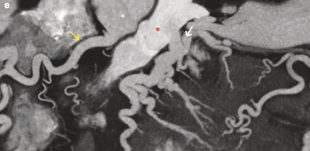 Anomalous left coronary from the pulmonary artery (ALPACA or Balnd-White-Garland syndrome)