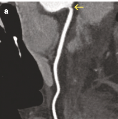 Moderate ostial RCA stenosis. PRedominantly non-calcified eccentric lesion with low-attenuation core