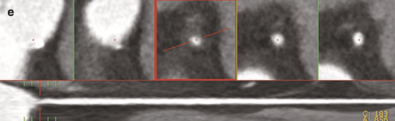 Linear low-density intraluminal image suggestive of focal dissection
