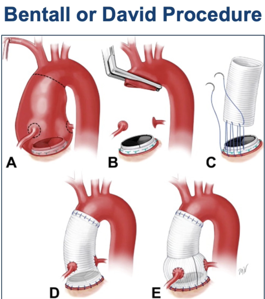 Bentall procedure for surgical aortic aneurysm repair