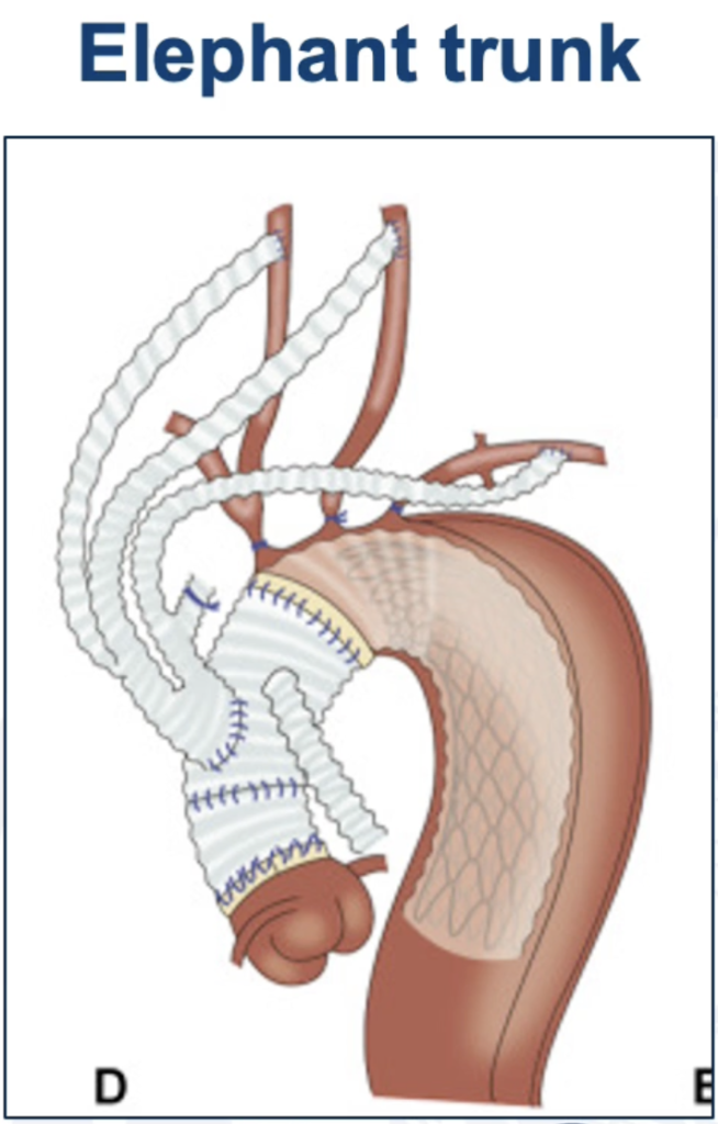 Elephant trunk for surgical aortic aneurysm repair